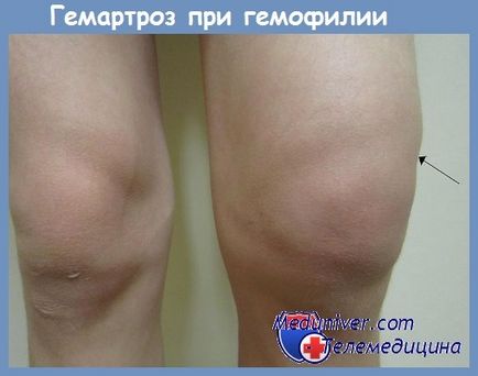 Clinica Hemofilie (VIII-C, respectiv, IX-C) clinica hemofilie