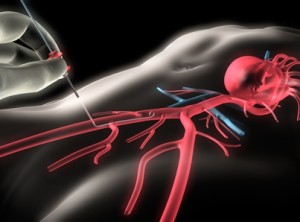 Efecte vasculare coronariene (vasele coronariene ale efectelor cardiace) vasele coronariene ale efectelor cardiace