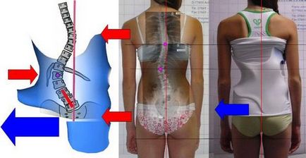 Corset la tipurile coloanei vertebrale toracice, scopul și utilizarea (departament) Corset la tipurile coloanei vertebrale toracice, scopul și utilizarea