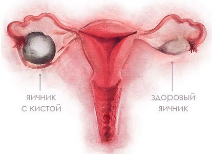 Luteale simptome ovarian chist si tratament (chist) Luteale simptome chist ovarian si tratament