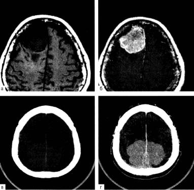 Imagistica prin rezonanta magnetica in neurologie