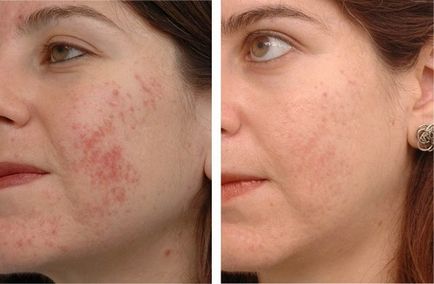 Mezoterapia de acnee (acnee), atunci când ea ajută la comentarii ca terminat (acnee) Mezoterapia de acnee (acnee) când ajută cum să facă, comentarii