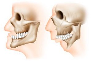 microgeny micrognatie și mandibulă (micrognatie) Micrognathia și microgeny mandibular