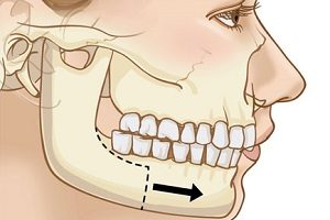 micrognathia Microgeny și mandibulară (maxilarului) Micrognathia și microgeny mandibular