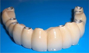 implant Bridge (proteze) Podul de pe implanturi