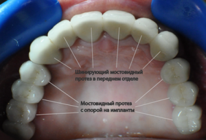 Podul pe implanturi (implanturi pod dentare) Podul de pe implanturi