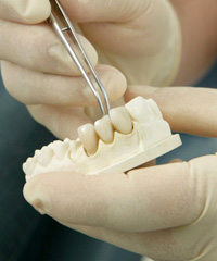 Podul pe implanturi (implanturi pod dentare) Podul de pe implanturi