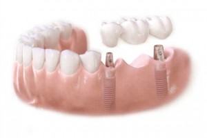 Podul pe implanturi (implanturi pod dentare) Podul de pe implanturi