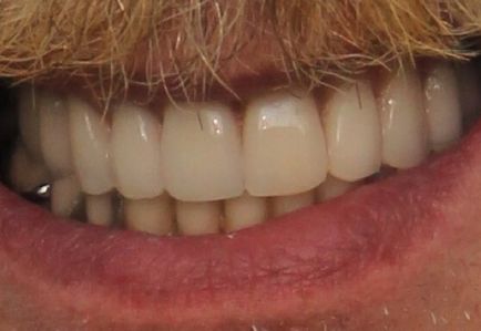 Podul implant - avantaje și dezavantaje (avantaj) Podul pe implanturi - avantaje și dezavantaje
