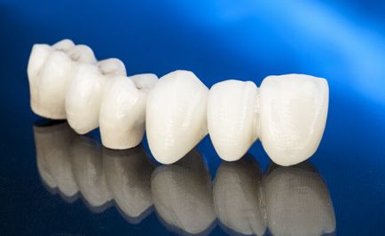Podul implant - avantaje și dezavantaje (implant) Podul pe implanturi - avantaje și dezavantaje