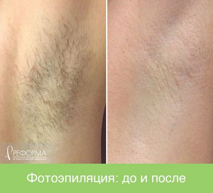 îndepărtarea părului pentru bărbați (de sex masculin) îndepărtarea părului pentru bărbați
