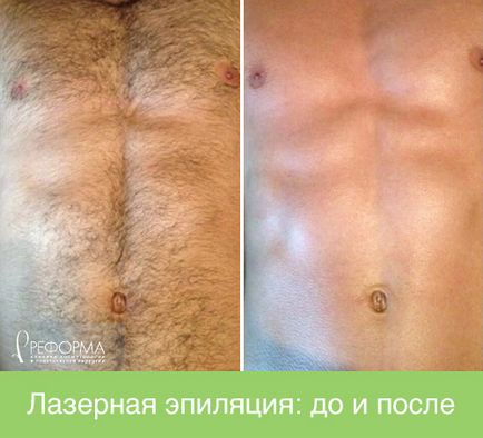 îndepărtarea părului pentru bărbați (bărbați clinici depilatoare) îndepărtarea părului pentru bărbați