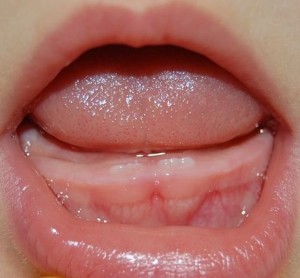 gingii tumefiate la sugari cauze, simptome și tratament (gume) gingii umflate la sugari cauze, simptome și tratament