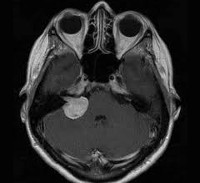 neuroma acustice - cauze, simptome, diagnostic si tratament (nerv) neuroma acustice - cauze, simptome, diagnostic și tratament