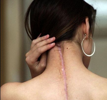Tipuri de spinale chirurgie, complicatii si reabilitare (reabilitare) Tipuri de chirurgia coloanei vertebrale, complicații și reabilitare