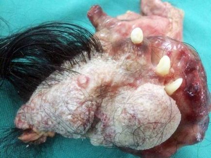 Tumora-parazit, cu părul și dinții (Fetus fetu embrion) Tumora-parazit, cu părul și dinții