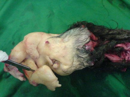 Tumora-parazit, cu părul și dinții (Fetus fetu embrion embrion) Tumora-parazit, cu părul și dinții