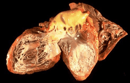 Tratamentul tumorii fotografie inima (tumori cardiace) Tumora de tratament fotografie inima