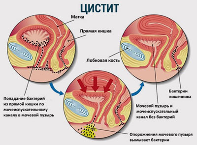 Senzația de un plin vezicii urinare motive principale (senzație) Senzația de un plin vezicale motive principale