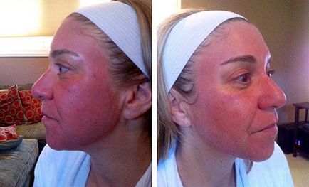 Complicații după cauze peeling, tratament (tratament) Complicațiile dupa peeling cauze, tratament