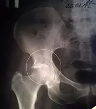 șold osteomielită, tratamentul și diagnosticarea (în comun) șold osteomielită, tratament si diagnostic