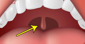 Umflarea uvula în gât (uvulit) cauze, din cauza pe care le poate crește, simptome și (gât) Umflarea uvula în gât (uvulit) cauze, din cauza care poate creste, simptome si