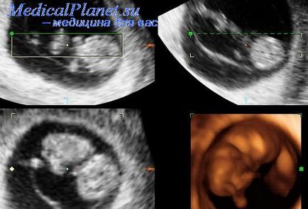 edem Placentar (umflare) edem placentar