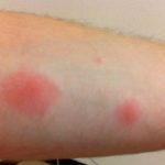 intoxicatii Mold, simptome și tratament, prevenirea otravire (intoxicare) intoxicatii mucegai, simptome și tratament de prevenire otravire