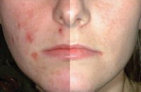 Opinii despre sistemul «Proactiv» de pete (pete de vârstă corectoare) Comentarii despre «Proactiv» sistem pentru acnee