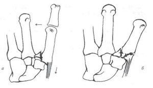 Fractura osului metacarpian cu deplasare și fără părtinire, tratament (metacarpiană) Fractura osului metacarpian cu deplasare și fără părtinire, tratament