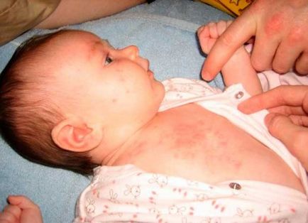 Sudamen sau alergie cum să se facă distincția între copii și adulți, o fotografie (copii) Sudamen sau alergie cum să se facă distincția între copii și adulți, fotografii