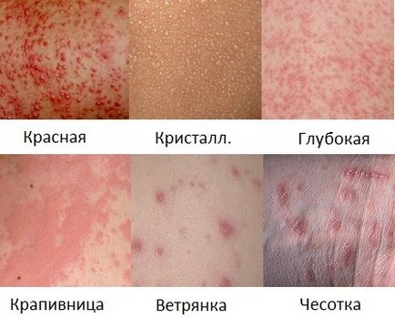 Sudamen sau alergie cum să se facă distincția între copii și adulți, o fotografie (adulți) Sudamen sau alergie cum să se facă distincția între copii și adulți, fotografii