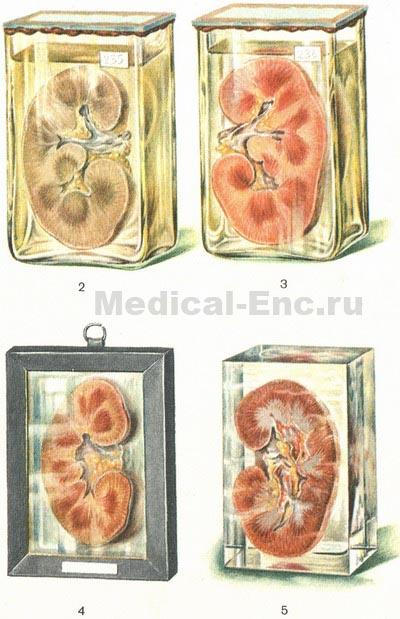 Formulările patologice (patologice) Preparate postmortem