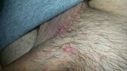 Acneea se datoreaza masturbare (in timpul actului sexual) Acnee se datorează masturbare