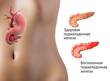 Semne, simptome de pancreatită și tratamentul său medical, pentru a vindeca complet posibil, acute (simptome) Semne, simptome de pancreatită și medicamente sale pot fi vindecate complet, acute