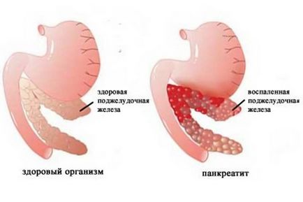 Semne, simptome de pancreatită și tratamentul său medical, pentru a vindeca complet posibil, acute (pancreatită) Semne, simptome de pancreatită și medicamente sale pot fi vindecate complet, acute
