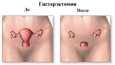 prolaps uterin (uter) prolaps uterin
