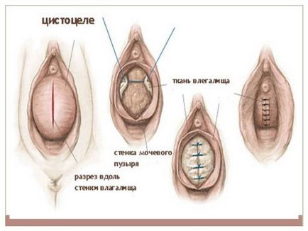 Prolapsul uterului (este important să se caute ajutor imediat) prolaps uterin
