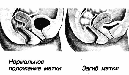 prolaps uterin (uter prolapsul Bend) prolaps uterin