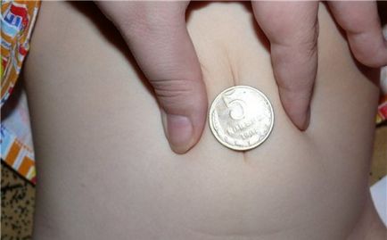 hernie ombilicala la tratamente sugari (trata hernie ombilicală) hernie ombilicala la tratamente sugari