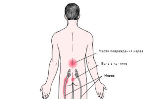 Sciatica - cauze, simptome si remedii populare tratamentul sciaticii (mijloace) Sciatica - cauze, simptome si remedii populare tratamentul sciaticii