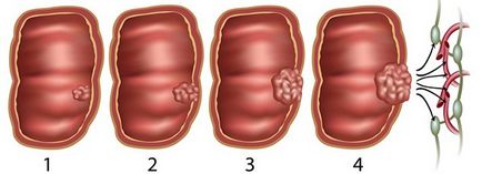 simptome de cancer intestinal la copii (copii) simptome de cancer intestinal la copii