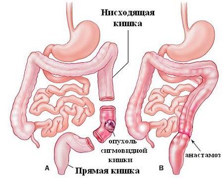 simptome de colon sigmoid bolilor si tratamentul lor