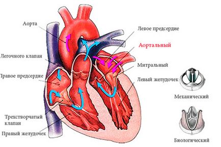 Simptomele aortice stenoza, tratament (tratament) simptome stenoza aortica, tratament