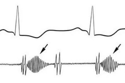 simptome stenoza aortica, tratamentul (stenoza de valva aortica) simptome stenoza aortica, tratament