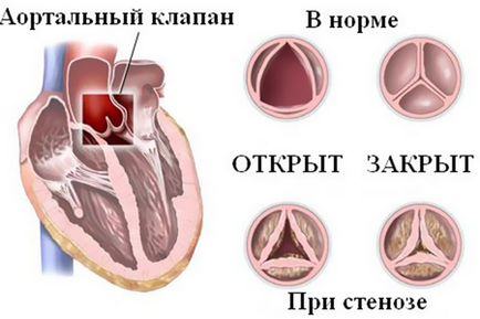 simptome stenoza aortica, tratamentul (aortic) simptome stenoza aortica, tratament