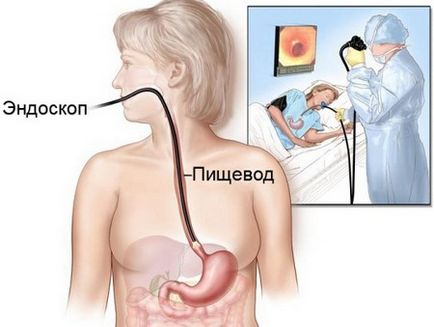 Îngustarea tipurilor esofag, simptomele si tratamentul strictura (esofag) Îngustarea a tipurilor de esofag, simptomele și tratamentul stricturii