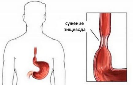 Îngustarea tipurilor esofag, simptomele si tratamentul strictura (ingustare stricturii esofagului determină prevenirea tratamentului simptomelor de formă de clasificare diagnostic) Îngustarea a tipurilor de esofag, simptomele și tratamentul stricturii