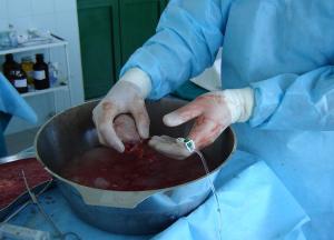 Ficatul și transplant renal, transplant de organe, lista de așteptare, Novgorod inferior, fbuz pomts FMBA (transplant) Ficat si transplantul de rinichi, transplantul de organe, lista de așteptare, de jos Novgorod, pomts fbuz FMBA