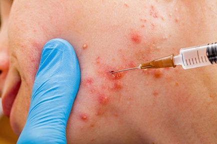 Injecțiile cu acnee - pe fata, gluconat de calciu, antibiotice, aloe, la cald, recenzii (preparate injectabile) Injecțiile cu acnee - pe fata, gluconat de calciu, antibiotice, aloe, la cald, comentarii